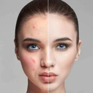 Best scar treatment at Borivali